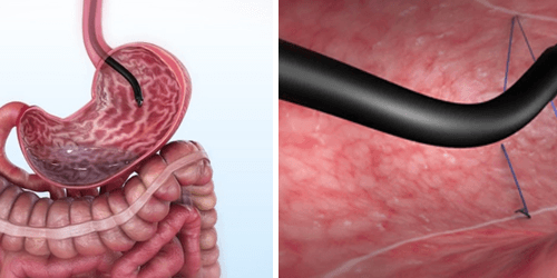 Gastroplastyprocedure1