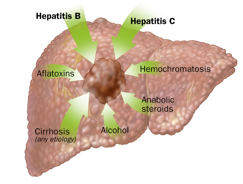 Causes_Hepatocellular_Carcinoma