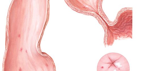 axalasia
