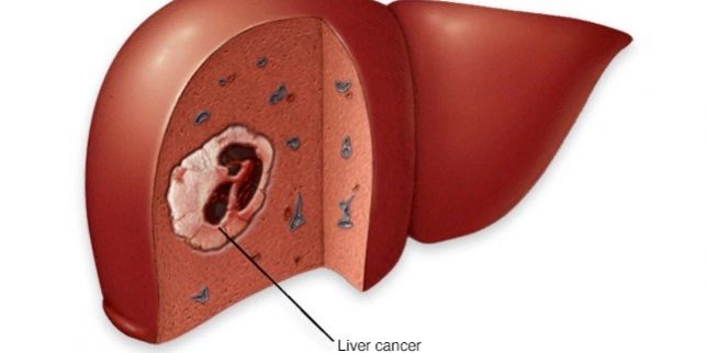 livercancer