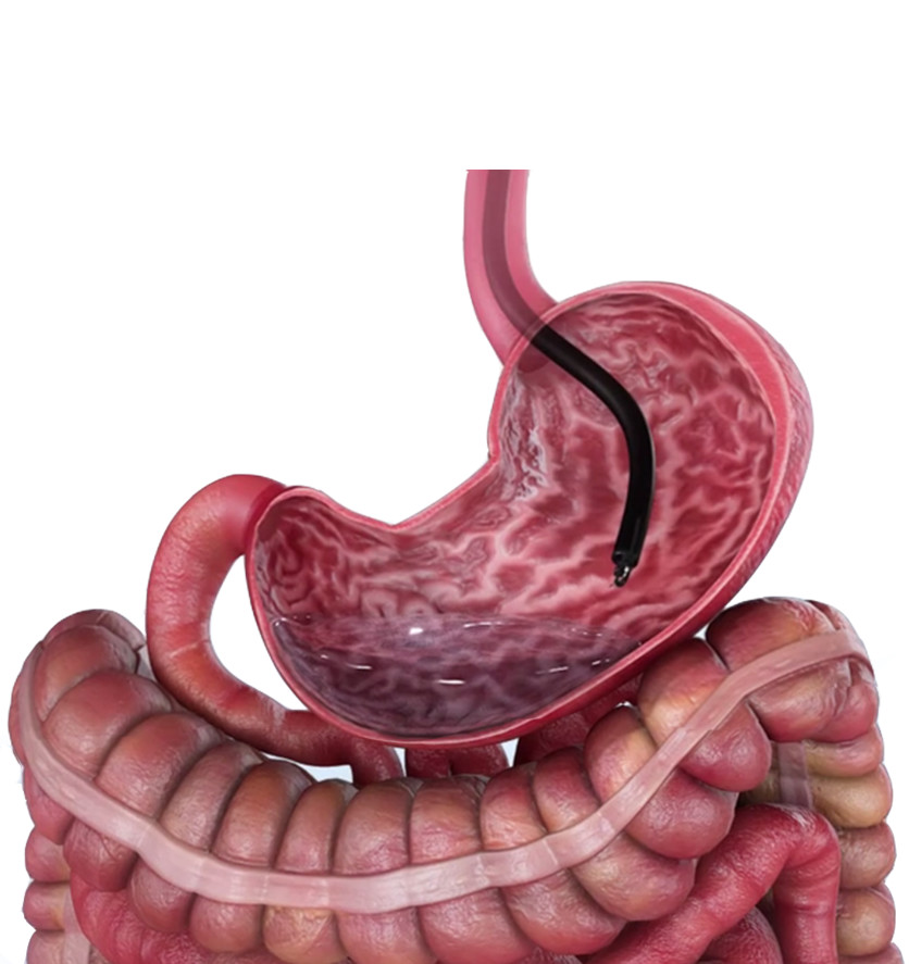overstitch-bariatric