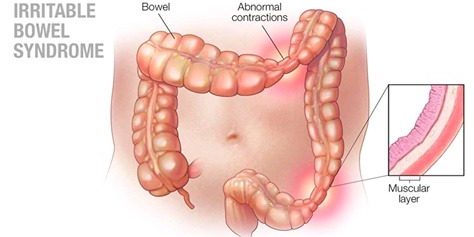 ibs