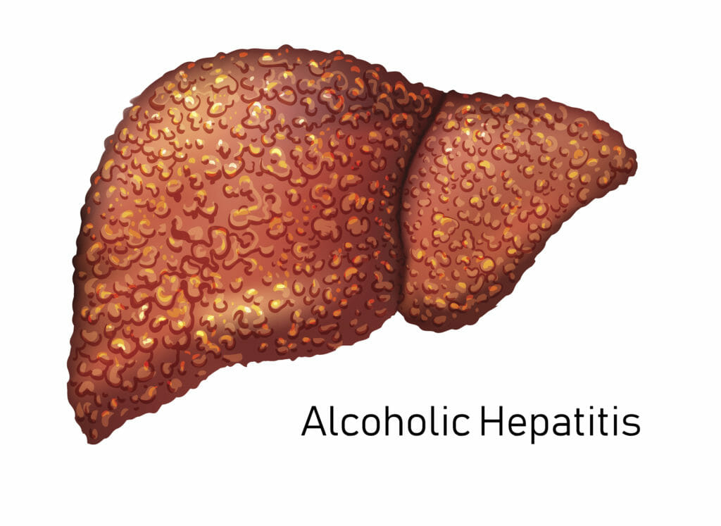alcoolic hepatitis 2